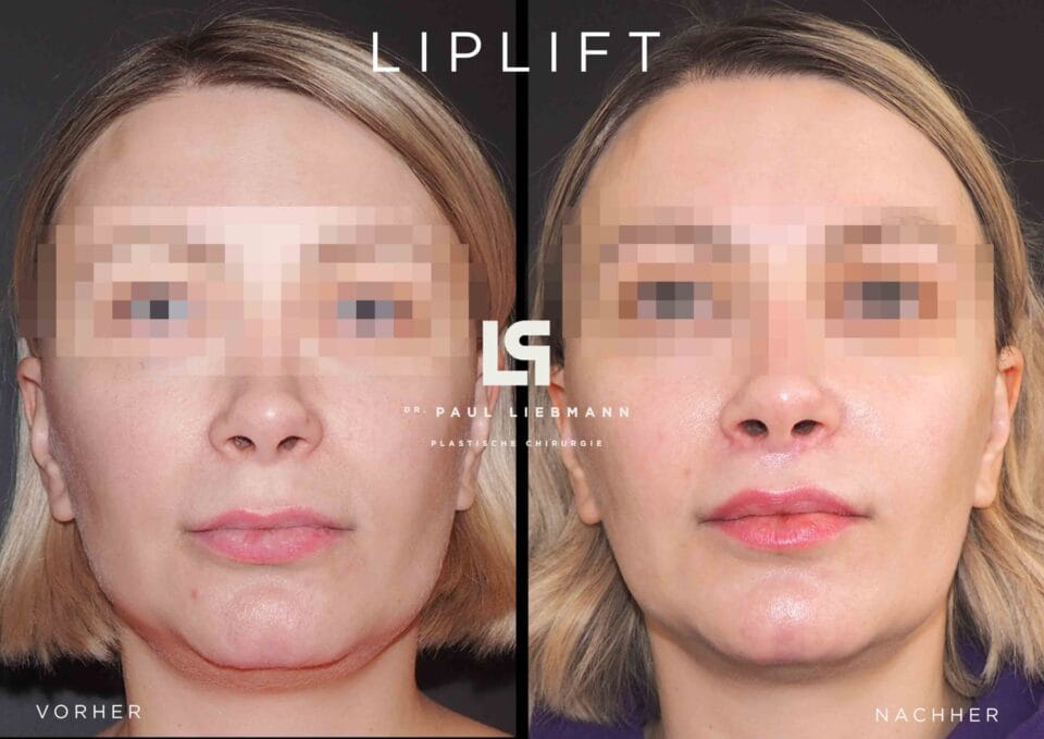 bullhorn lip lift