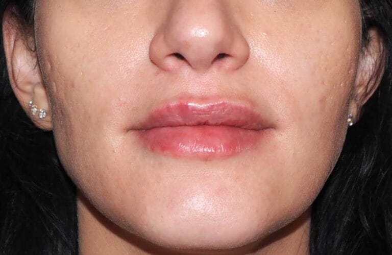 Frauen Lippen aufgespritzt von vorne