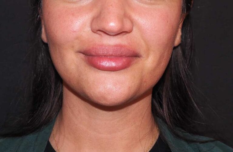 Frau mit Lippen Filler