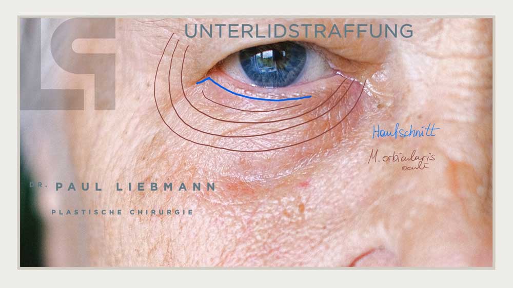 Schnittführung Unterlidstraffung