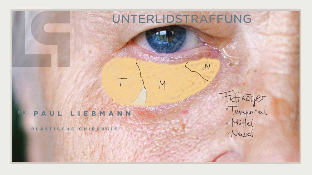 Fettkörper Augen