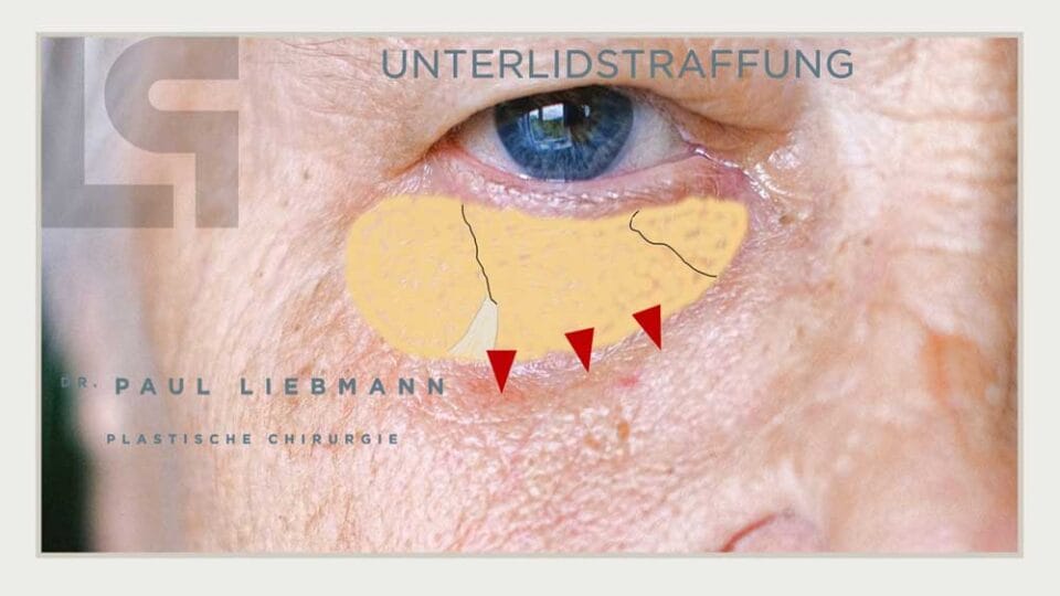 Bild zeigt Unterlidstraffung