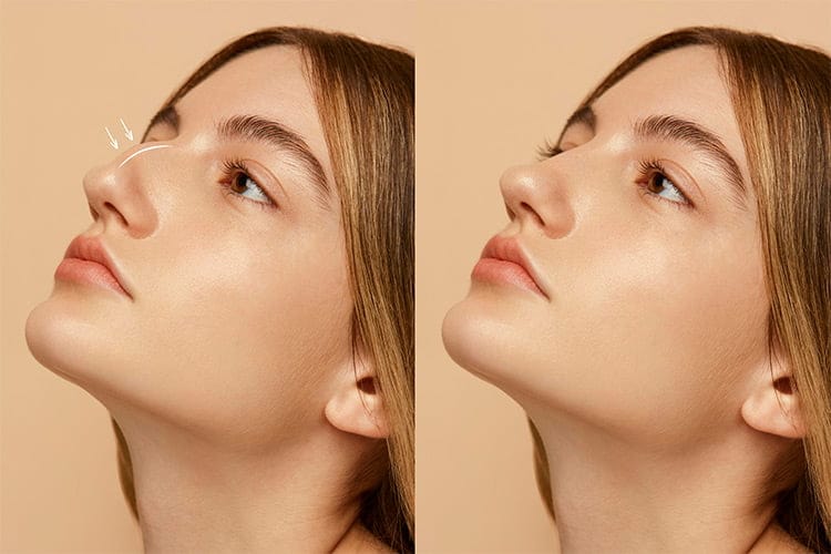 Bild zeigt Rhinoplastik