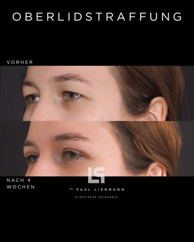 Oberlidstraffung: 4 Wochen postoperativ

Viele Patientinnen fragen vor dem Eingriff, wie lange die Ausfallzeit dauert und wie sichtbar die Narben sind. Dieses Nachher-Bild wurde 4 Wochen nach der Oberlidstraffung (obere Blepharoplastik) aufgenommen: Die Heilung verläuft planmäßig, die Narben sind bereits sehr unauffällig. In der Regel ist die gesellschaftliche Ausfallzeit nach etwa 7–10 Tagen überwunden. Das endgültige Ergebnis zeigt sich schrittweise im Verlauf der ersten Wochen.

Terminvereinbarung für ein persönliches Beratungsgespräch gerne unter:
📞 0664 2215184
🌐 www.drliebmann.at
✉️ office@drliebmann.at
📩 per DM