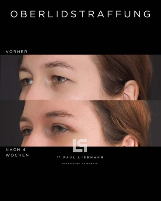 Oberlidstraffung: 4 Wochen postoperativ

Viele Patientinnen fragen vor dem Eingriff, wie lange die Ausfallzeit dauert und wie sichtbar die Narben sind. Dieses Nachher-Bild wurde 4 Wochen nach der Oberlidstraffung (obere Blepharoplastik) aufgenommen: Die Heilung verläuft planmäßig, die Narben sind bereits sehr unauffällig. In der Regel ist die gesellschaftliche Ausfallzeit nach etwa 7–10 Tagen überwunden. Das endgültige Ergebnis zeigt sich schrittweise im Verlauf der ersten Wochen.

Terminvereinbarung für ein persönliches Beratungsgespräch gerne unter:
📞 0664 2215184
🌐 www.drliebmann.at
✉️ office@drliebmann.at
📩 per DM