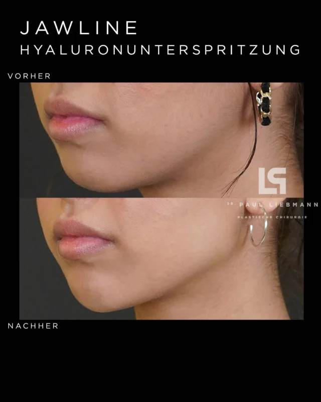 #beautiful result! So entsteht eine natürliche, markante #jawline !! Beim #contouring der #Kinnlinie verwenden wir den #filler #hyaluron - wenn du mehr Infos wünscht komm in unserer Ordination in #wien vorbei
. 
. 
. 
☎️Telefon:+436642215184
🌍Homepage:www.drliebmann.at
📩Email:office@drliebmann.at
📍Wo: Rossauer Lände 17/17, 1090 Wien