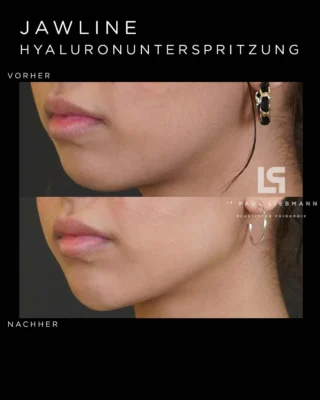 #beautiful result! So entsteht eine natürliche, markante #jawline !! Beim #contouring der #Kinnlinie verwenden wir den #filler #hyaluron - wenn du mehr Infos wünscht komm in unserer Ordination in #wien vorbei
. 
. 
. 
☎️Telefon:+436642215184
🌍Homepage:www.drliebmann.at
📩Email:office@drliebmann.at
📍Wo: Rossauer Lände 17/17, 1090 Wien