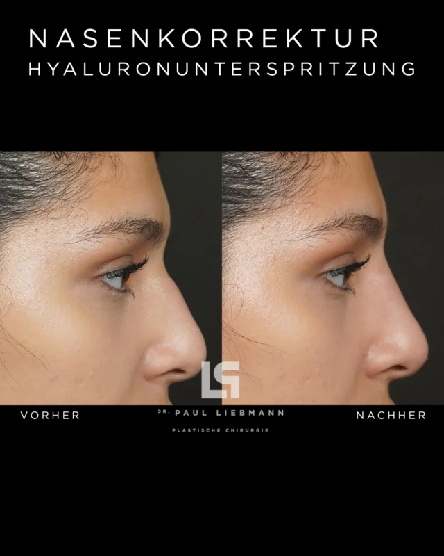 Mit einer minimalinvasiven Behandlung können bereits kleine Veränderungen große Wirkung erzielen.
Durch präzise Injektionen mit Hyaluronsäure lässt sich das Nasenprofil harmonisieren, ganz ohne Operation, mit sofort sichtbarem Ergebnis. 

✔ ambulant & nahezu schmerzfrei 
✔ sofort gesellschaftsfähig 
✔ natürliche Ergebnisse