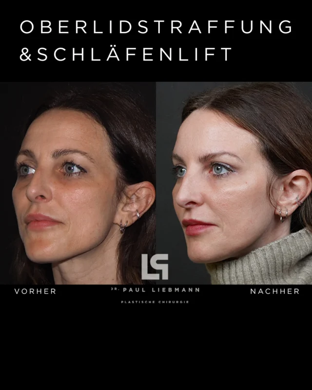 Ein offenerer Blick, fein definierte Konturen und neue Frische –
ohne die Persönlichkeit zu verändern.

Oberlid- & Brauenlifting für ein Ergebnis, das authentisch wirkt
und die individuelle Ausstrahlung bewahrt.

Natürlichkeit erhalten. Schönheit unterstreichen.

#vorhernachher #oberlidstraffung #brauenlifting #ästhetik