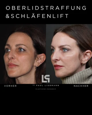 Ein offenerer Blick, fein definierte Konturen und neue Frische –
ohne die Persönlichkeit zu verändern.

Oberlid- & Brauenlifting für ein Ergebnis, das authentisch wirkt
und die individuelle Ausstrahlung bewahrt.

Natürlichkeit erhalten. Schönheit unterstreichen.

#vorhernachher #oberlidstraffung #brauenlifting #ästhetik